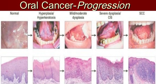 The Warning Signs Symptoms Of Mouth Cancer Emergency Dentist 